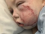 Menina de 4 anos leva mais de 40 pontos no rosto por mordida de cachorro