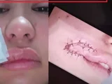 Assaltante que mordeu rosto de jovem durante assalto tem prisão preventiva decretada
