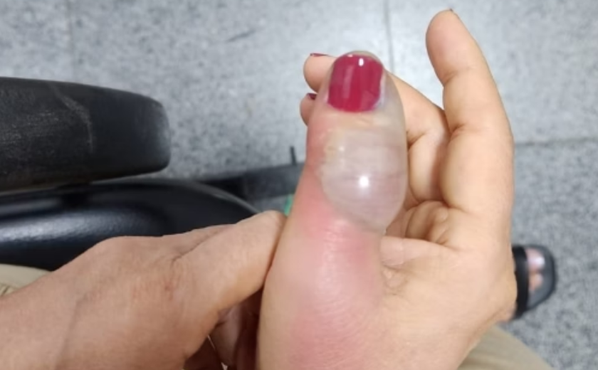 Idosa sofre infecção grave após fazer as unhas em salão