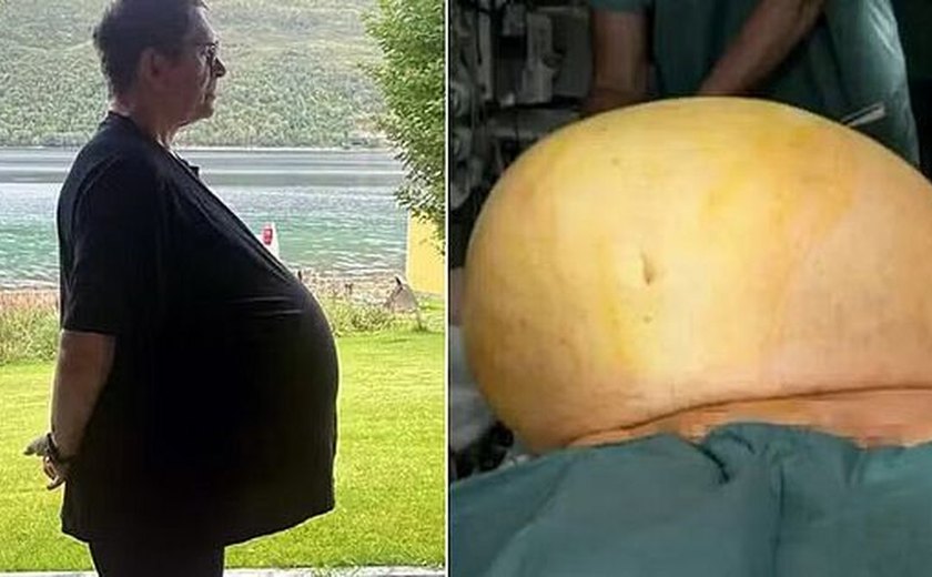 Médico descobre que 'obeso' tratado com Ozempic tinha na verdade um tumor de 27kg