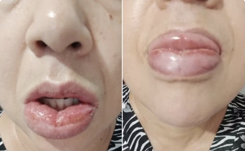 Mais de 1,2 mil pessoas relataram reação a pasta da Colgate; venda segue proibida