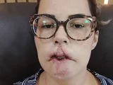 Mulher perde lábio após preenchimento de PMMA: “Tristeza e raiva”