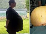 Médico descobre que 'obeso' tratado com Ozempic tinha na verdade um tumor de 27kg