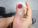 Idosa sofre infecção grave após fazer as unhas em salão