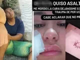 Jovem que mordeu rosto de turista paraguaia durante assalto em Maceió vira réu