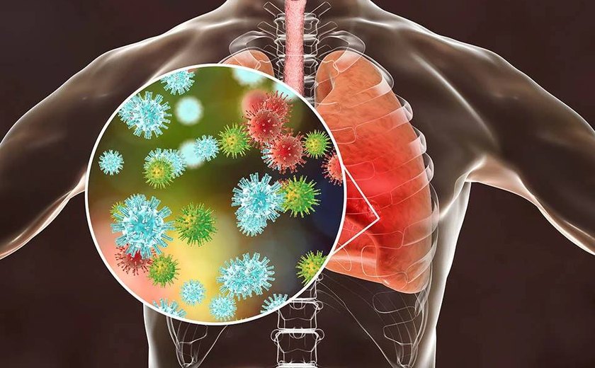 OMS monitora surto misterioso de pneumonia na Argentina