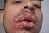 Caso de herpes labial grave alerta foliões sobre cuidados durante o Carnaval
