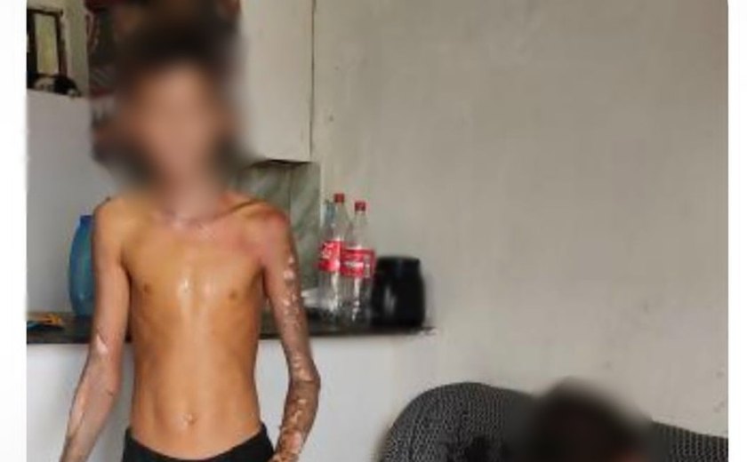 Adolescente ferido em explosão de fogos de artifício em Ibateguara teve 60% do corpo queimado