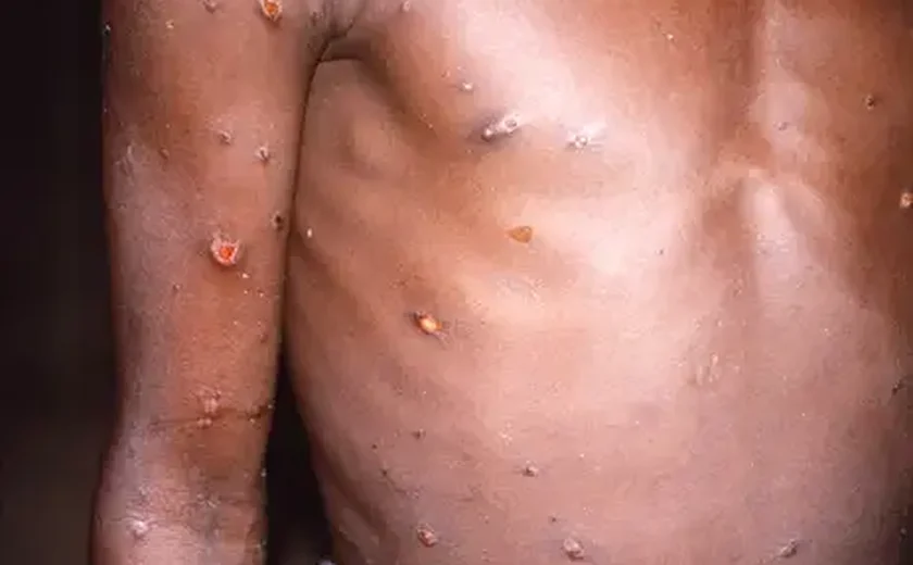 Mpox: conheça sintomas e tire principais dúvidas sobre a doença