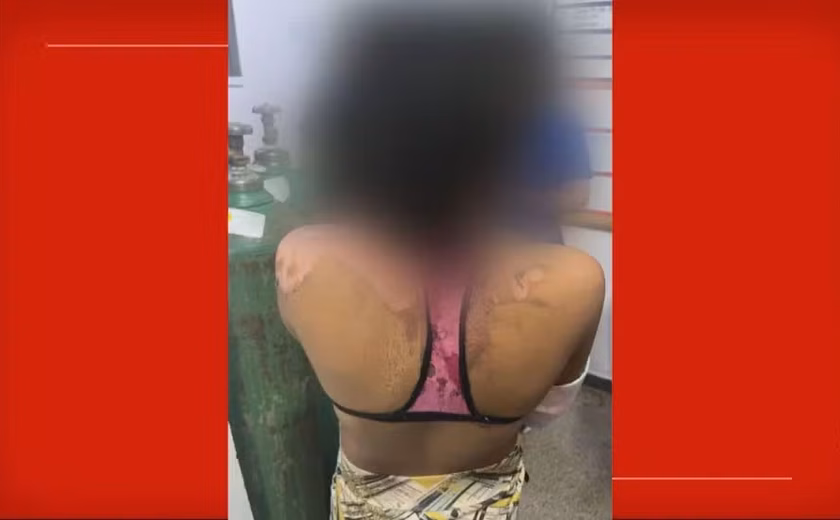 Jovem de 14 anos é queimada com água quente pela tia por causa de ciúmes
