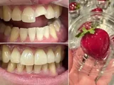 Dentistas alertam sobre riscos do ‘morango do amor’ para a saúde bucal; 7 casos de fraturas já foram registrados