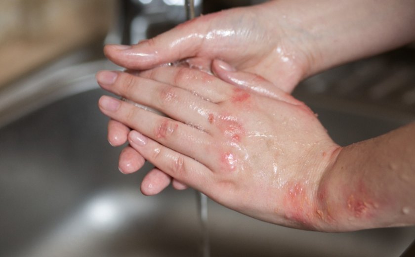 Três pessoas ficam com queimaduras após briga familiar em Cacimbinhas