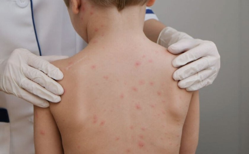 Estudante é diagnosticado com meningite em colégio particular de Maceió