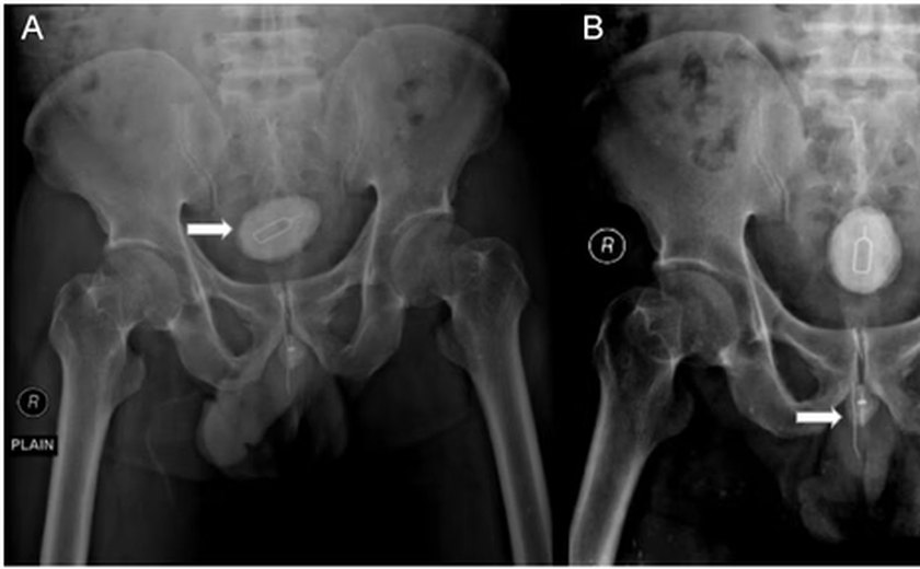 Homem passa por cirurgia após enfiar chave Para retirar chip, cabo elétrico e elástico do pênis