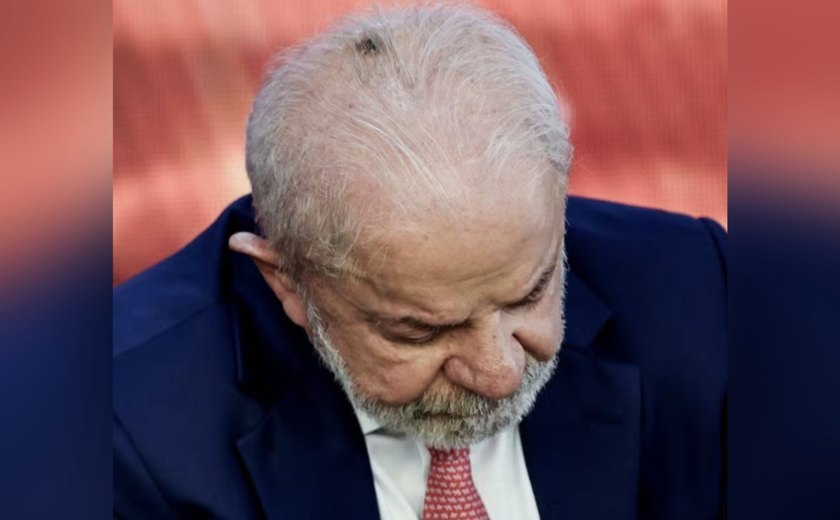 Médico de Lula diz que lesão de pele retirada da cabeça do presidente é comum e não trará restrições