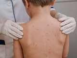 Alerta em Alagoas: Meningite já fez vítimas fatais em 2024 e vacinação é a única proteção real