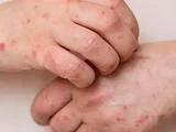 Casos de monkeypox se aproximam de 100 mil em todo o mundo, alerta OMS