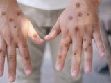 Porto Alegre confirma caso de Mpox e reforça alerta durante o Carnaval
