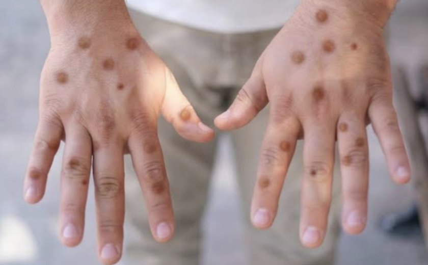 Porto Alegre confirma caso de Mpox e reforça alerta durante o Carnaval