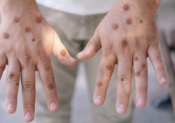 Porto Alegre confirma caso de Mpox e reforça alerta durante o Carnaval