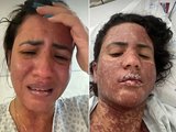 Mulher de Frank Aguiar relata internação na UTI com doença rara que queima a pele