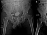 Homem passa por cirurgia após enfiar chave Para retirar chip, cabo elétrico e elástico do pênis