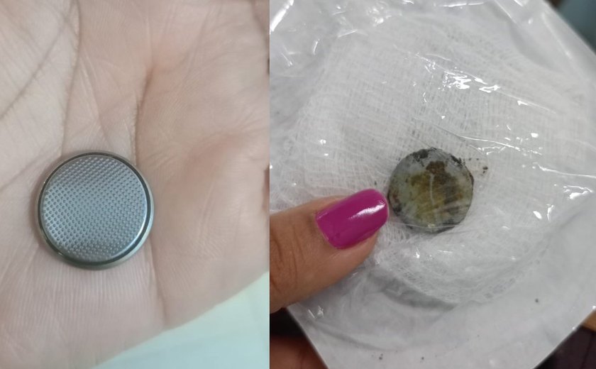 Menino de 6 anos é hospitalizado após engolir pilha em desafio com irmã em Maceió