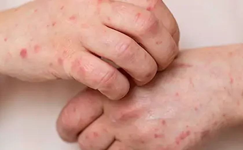 Casos de monkeypox se aproximam de 100 mil em todo o mundo, alerta OMS