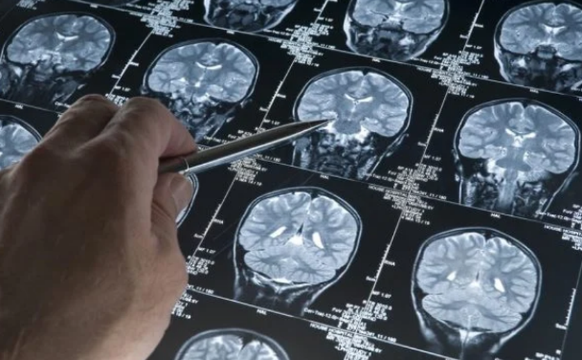 Exame de sangue poderá detectar Alzheimer com antecedência, diz estudo