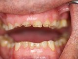 Hábito de ranger os dentes pode causar vários prejuízos, mas há tratamento