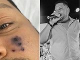 Cantor de forró morre após picada de aranha, diz família; rosto do homem começou a escurecer