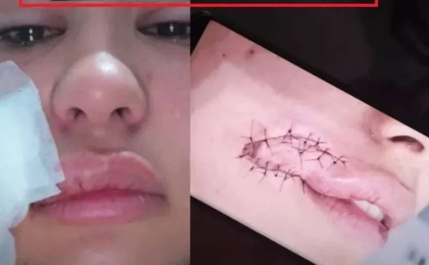 Assaltante que mordeu rosto de jovem durante assalto tem prisão preventiva decretada