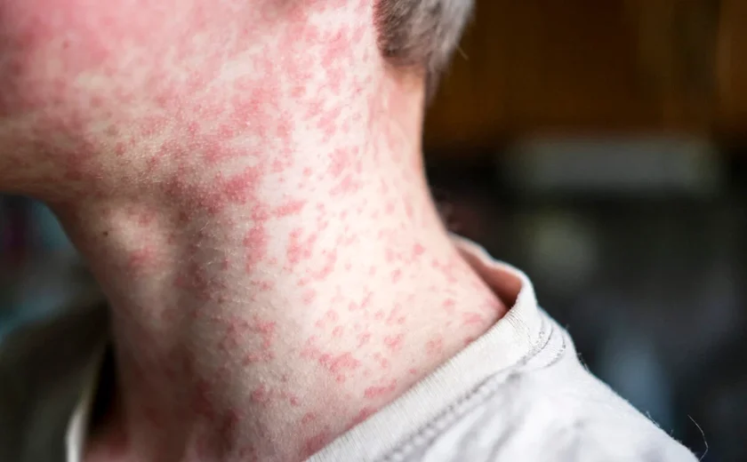 Ministério da Saúde alerta para risco de casos de sarampo após Copa