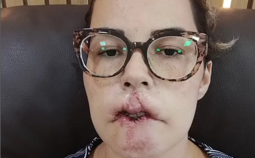 Mulher perde lábio após preenchimento de PMMA: “Tristeza e raiva”