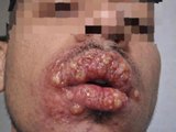 Caso de herpes labial grave alerta foliões sobre cuidados durante o Carnaval
